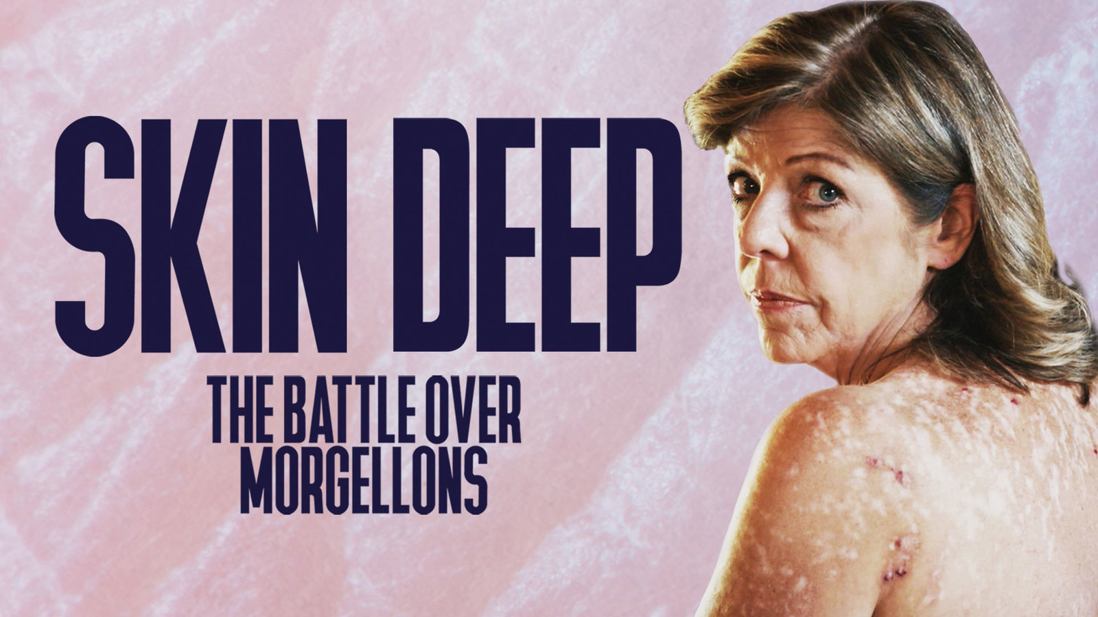 Skin Deep: The Battle Over Morgellons
