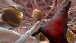 Can Alzheimer's Be Stopped?